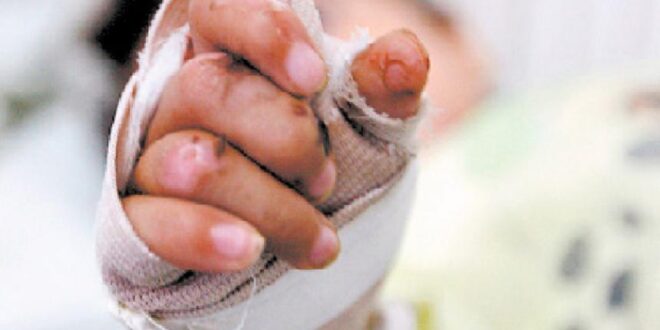 Cúcuta y Ocaña, las zonas con más casos de lesionados por pólvora este diciembre