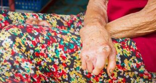 ¿Lepra en Norte de Santander? Esto es lo que realmente preocupa