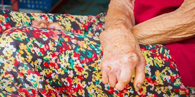 ¿Lepra en Norte de Santander? Esto es lo que realmente preocupa